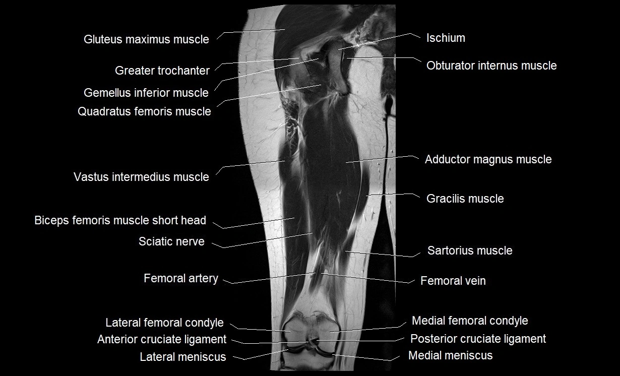 MRI thigh coronal cross sectional anatomy image 15.webp
